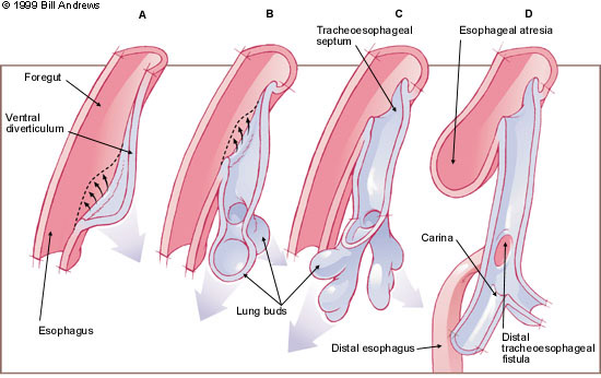Esophageal Atresia And Tracheoesophageal Fistula Aafp