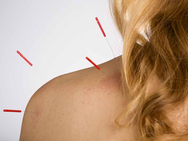 woman with acupuncture needles in shoulder