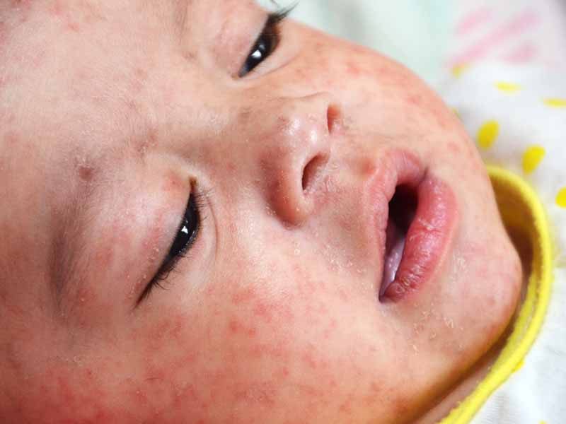 new measles update