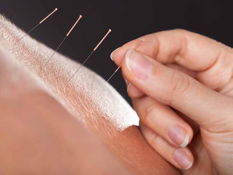 clinical practitioner placing acupuncture needles