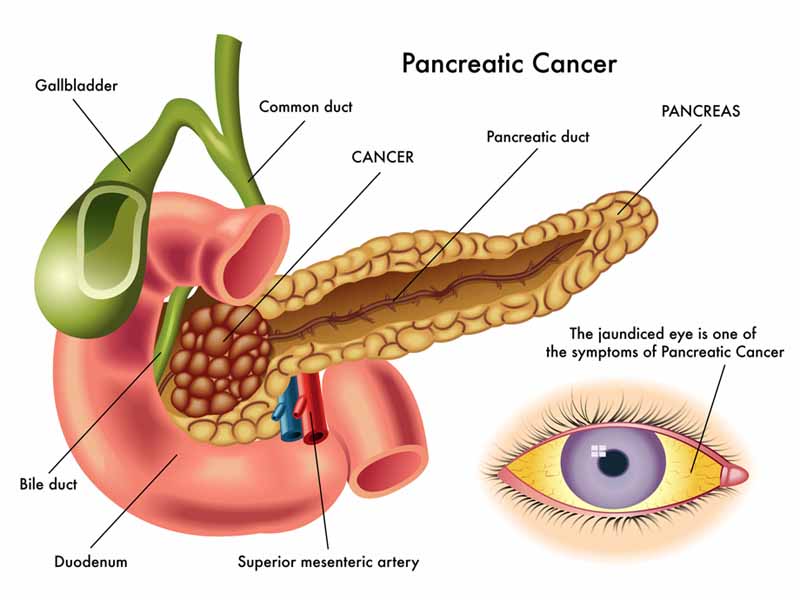 illustration of pancreatic cancer