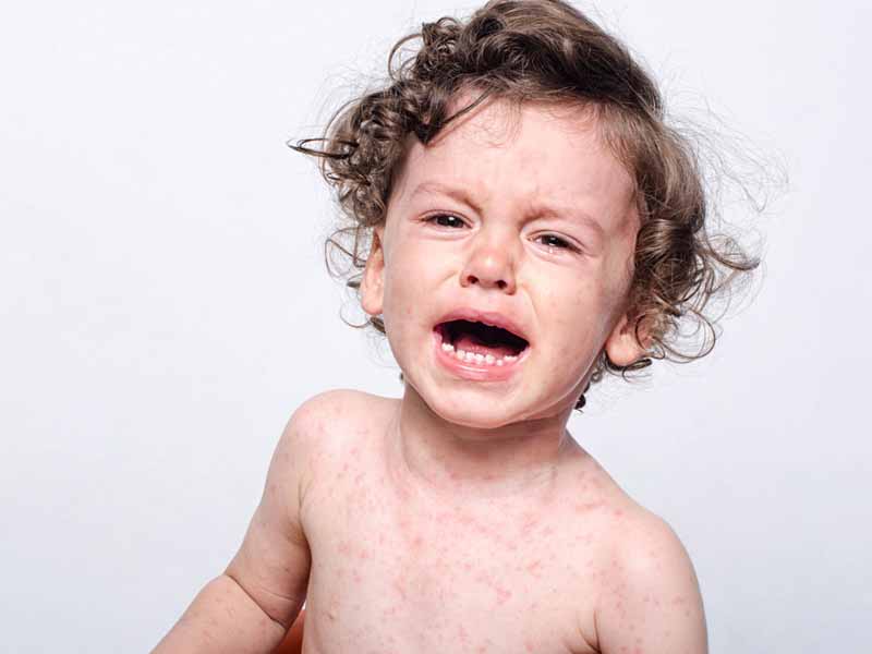 crying young child with measles 