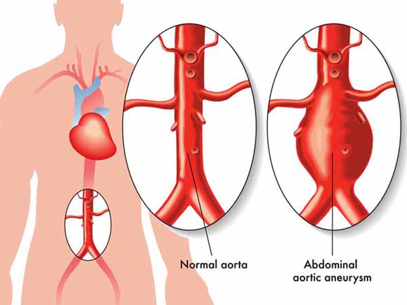 11864444 - abdominal aortic aneurysm
