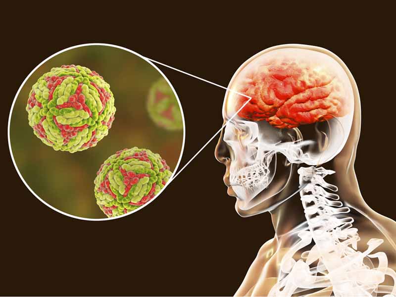 cutaway view illustrating bacteria causing brain disease
