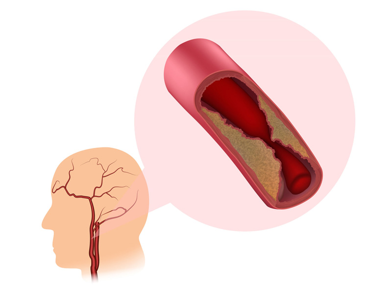 carotid artery stenosis illustration