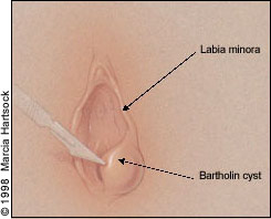 Office Management of Bartholin Gland Cysts and Abscesses