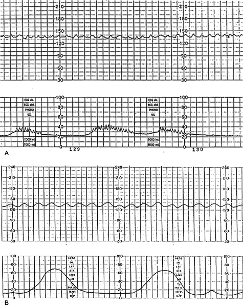 What fetal heart rate monitoring can – and can't – tell us