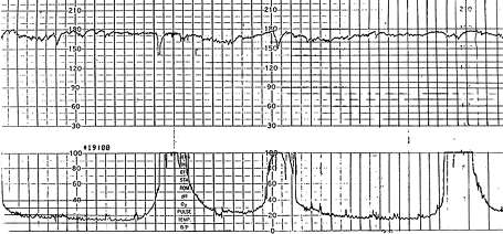 What fetal heart rate monitoring can – and can't – tell us