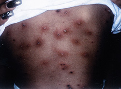 Figure. Maculopapular rash with diffuse petechiae, with areas of normal