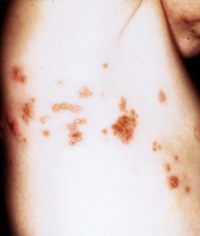 Evaluating the Febrile Patient with a Rash