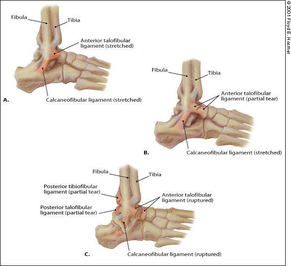 Management of Ankle Sprains | AAFP