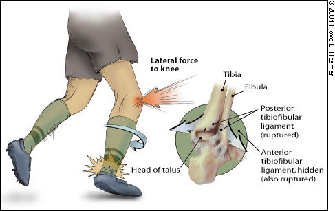 Management of Ankle Sprains | AAFP