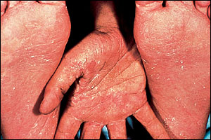 Two Feet-One Hand Syndrome: Tinea Pedis and Tinea Manuum