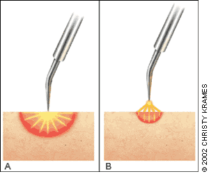 Electrocautery  Rederm Medical Center