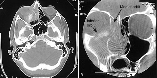 Radiologic in Management of Sinusitis AAFP