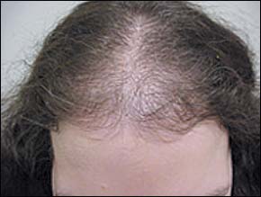 Common Hair Loss Disorders | AAFP