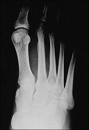 Common Stress Fractures | AAFP