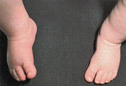 Detect Baby Foot Problems Early