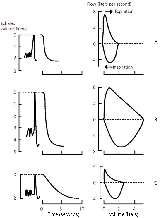 Obstructive Vs Restrictive Lung Disease Spirometry