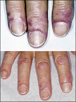 Common Skin and Nail Conditions of the Lower Extremity: Part 3 | Lower  Extremity Review Magazine