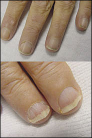 Nails in nutritional deficiencies - Indian Journal of Dermatology,  Venereology and Leprology
