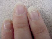 Nail disorders and systemic disease What the nails tell us  MDedge Family  Medicine