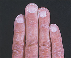 Proximal White Finger Nails | AAFP