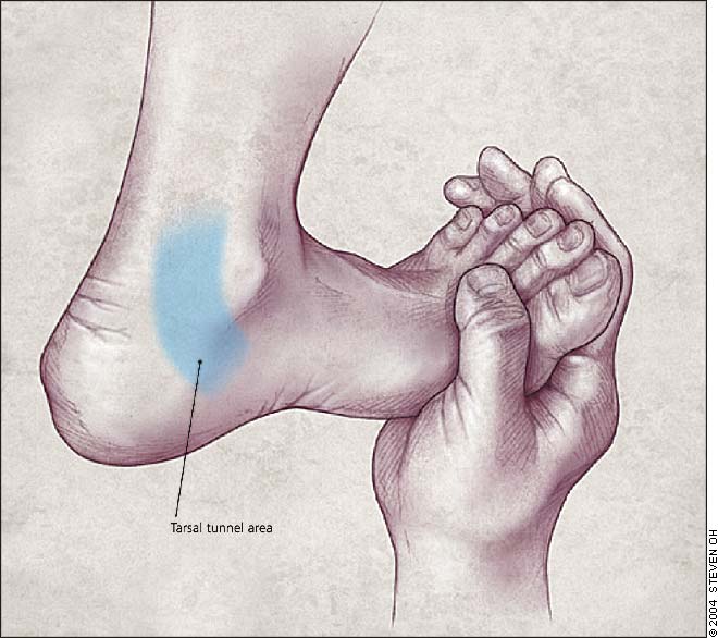Common Heel Injuries and Causes of Pain - footsurgeon-totobed.com.vn