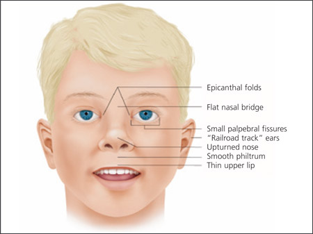 fetal alcohol syndrome statistics