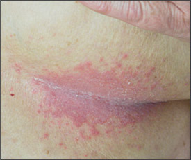 MyMed.com on X: Intertrigo-inflammatory skin rash that occurs due