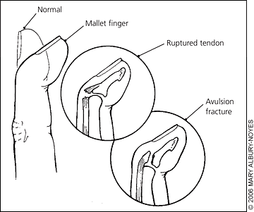 Common basketball finger injuries