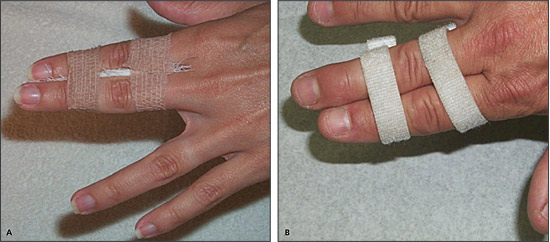Finger Injuries, Finger Disorders