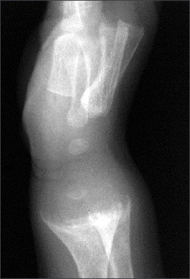 case study of rickets