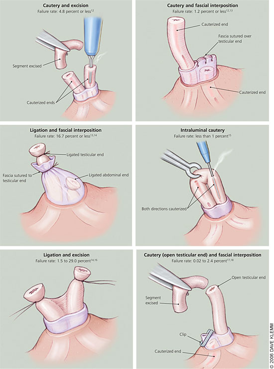 Vasectomy: An Update