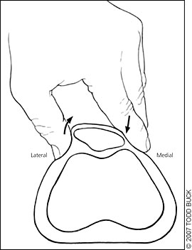 Example of patellar orientation with a lateral glide and/or tilt