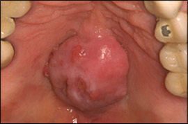 buket at tilføje Anklage Common Oral Lesions: Part II. Masses and Neoplasia | AAFP