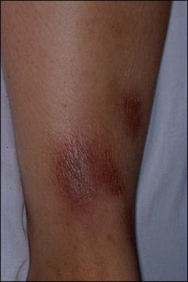 erythema nodosum