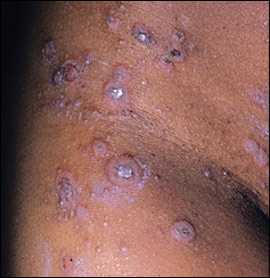 bullous impetigo in children