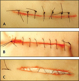 Adhesive tape, stitches, staples, zipper, glue: How to choose