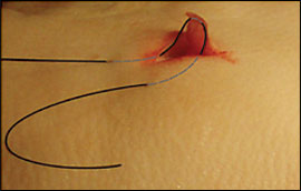 Lacerations: Does closure technique matter? - First10EM