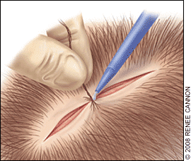 Pediatric Corner: Here's how to avoid problems with Dermabond