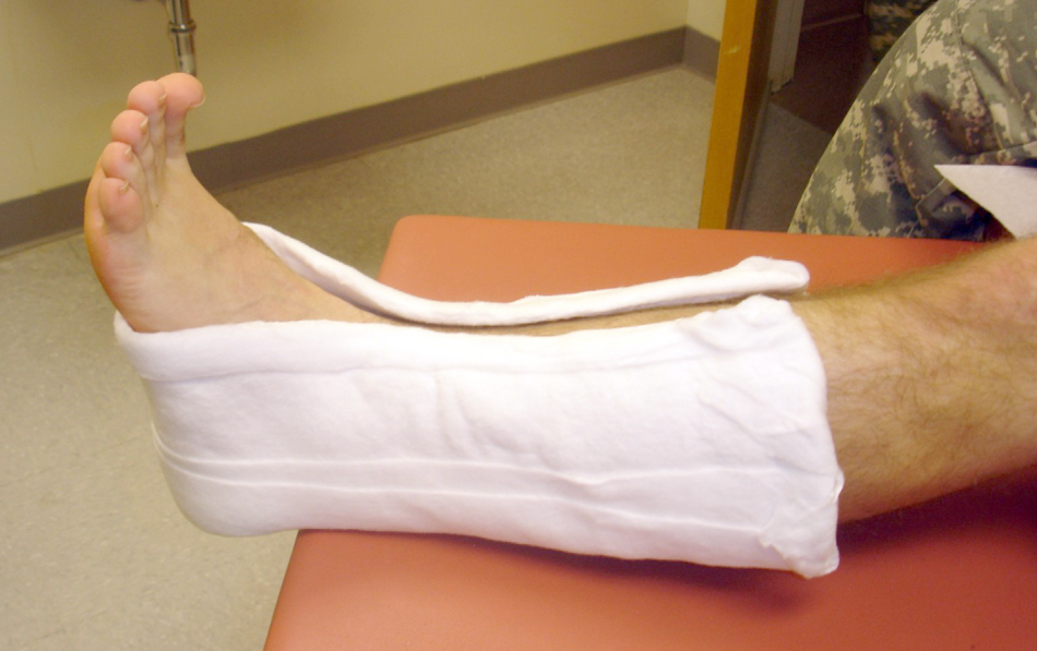 Types of Short Arm Casts: Which One Is Right for You?