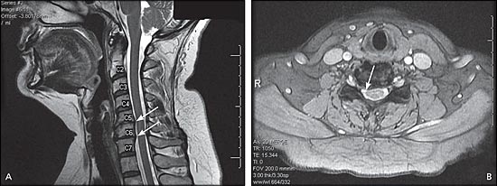 Cervical Radiculopathy (Pinched Nerve in Neck): Symptoms & Treatment