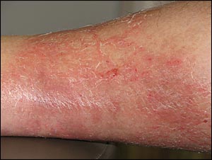 Skin Infections Caused by Staphylococcus aureus, HTML