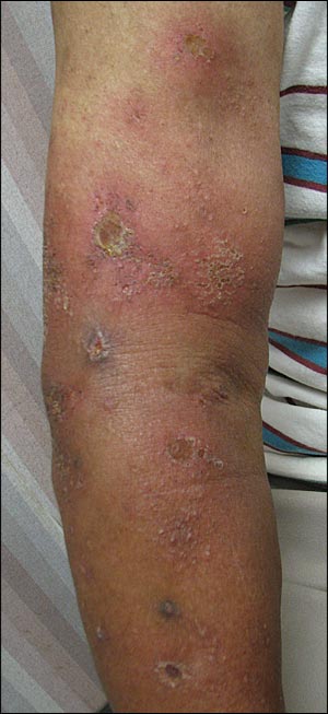 Skin And Soft Tissue Infections In Immunocompetent Patients Aafp
