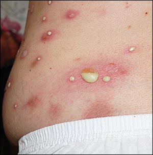 bullous impetigo in children