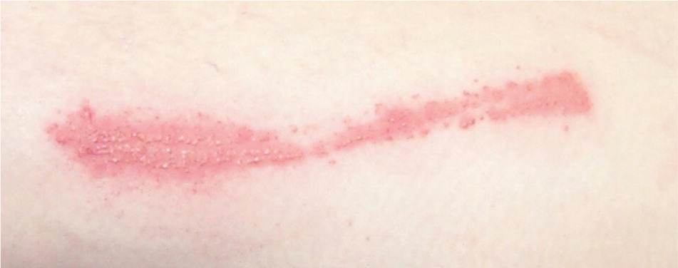 Diagnosis And Management Of Contact Dermatitis Aafp