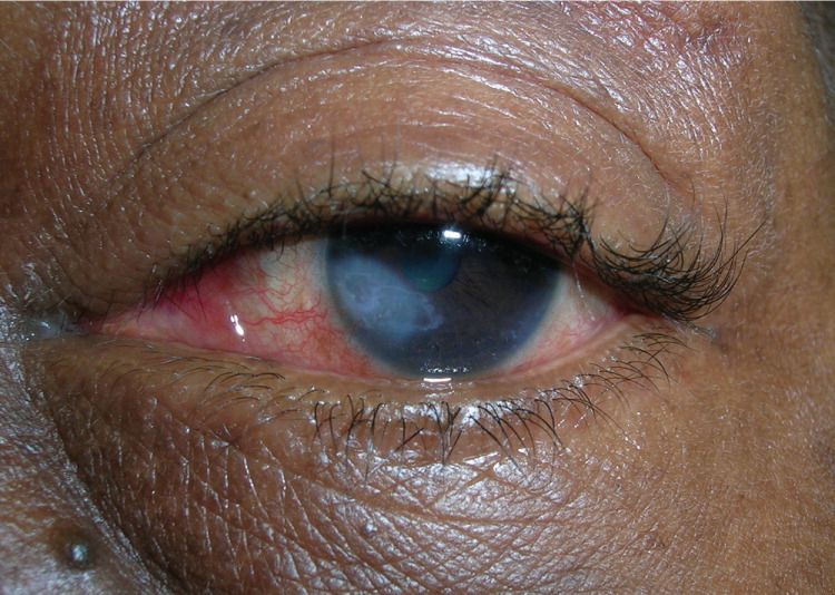 cold sores on eyes