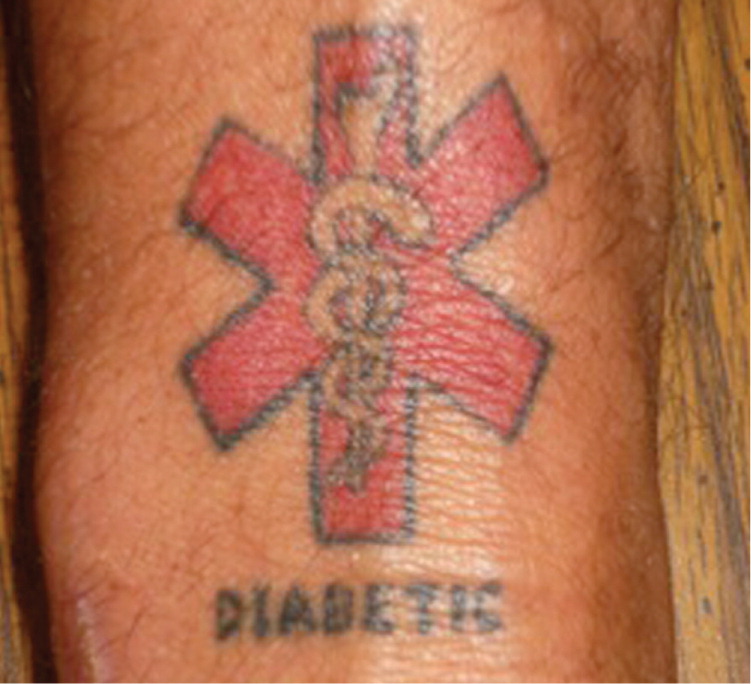 A Medical Alert Tattoo | AAFP