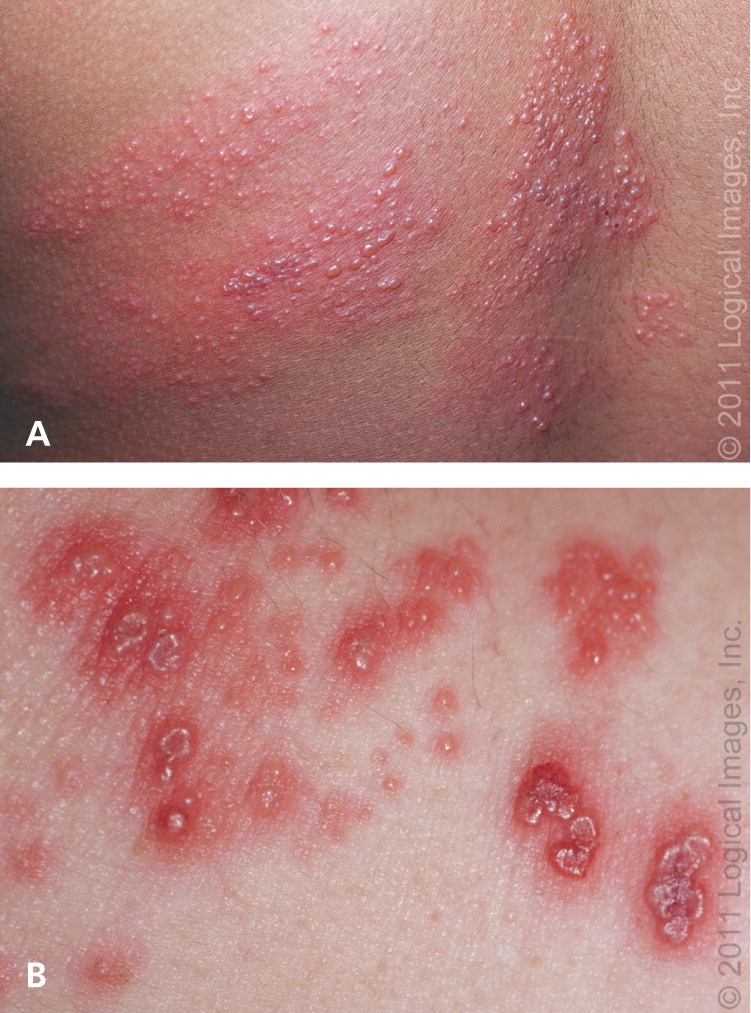 clinical presentation of herpes zoster